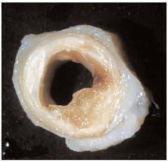 rigidità arteriosa e demineralizzazione ossea